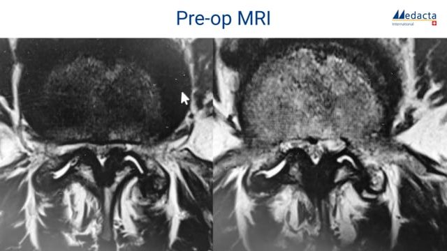 MySpine MC - Live surgery with 3D animations